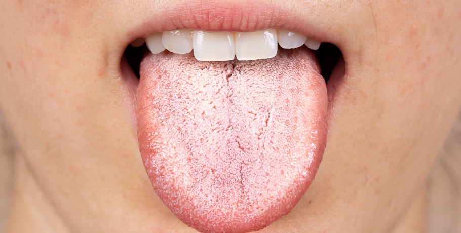 Quais são os sintomas de crescimento excessivo de Candida ou de outros fungos? Quais são os sintomas de crescimento excessivo de Candida ou de outros fungos?